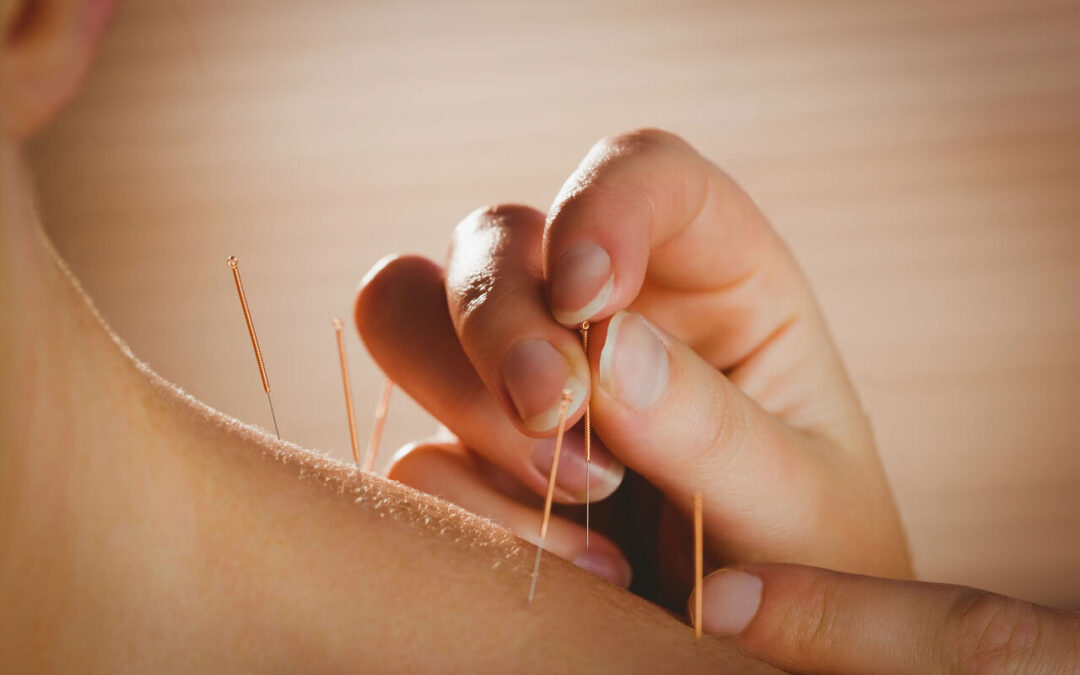 Journey to Better Health: The Incredible Benefits of Acupuncture