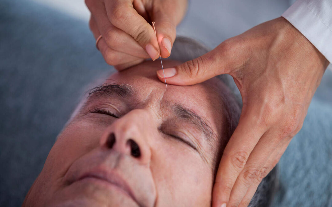 Saying Goodbye to Headaches: Our Journey with Acupuncture Treatment