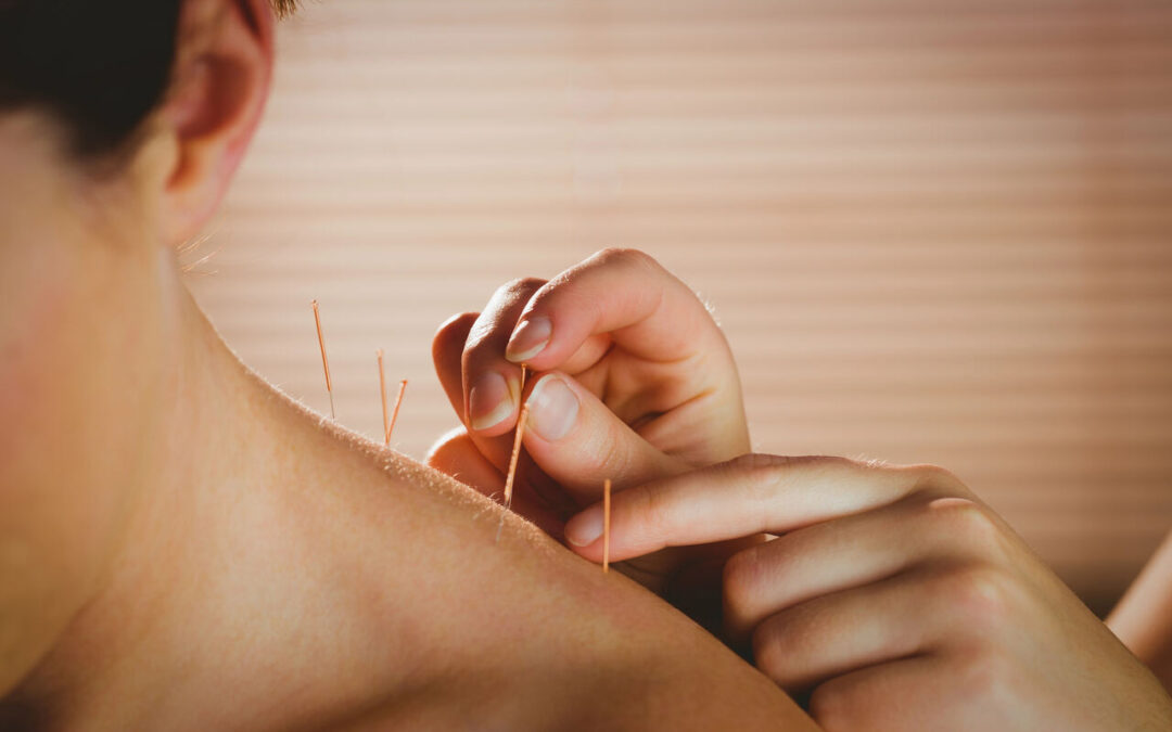 Our Guide to Acupuncture for Neck Pain Relief: What You Need to Know